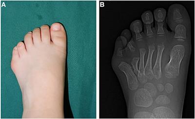 On-Top Plasty at the Level of the Metatarsal Neck for Treatment of Polydactyly